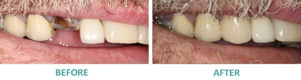 Dental Implants Sunshine Coast | Dental Implant Replacing Missing Tooth Upper Arch