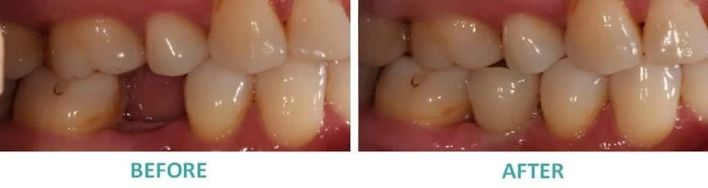 Dental Implants Sunshine Coast | Dental Implant Replacing Missing Pre-Molar