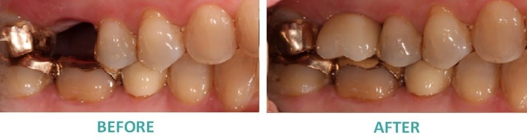 Dental Implants Sunshine Coast | Dental Implant Replacing Upper Molar