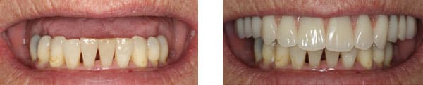 Full Mouth Dental Implants Sunshine Coast 1