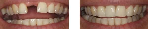 Single Tooth Dental Implants Sunshine Coast