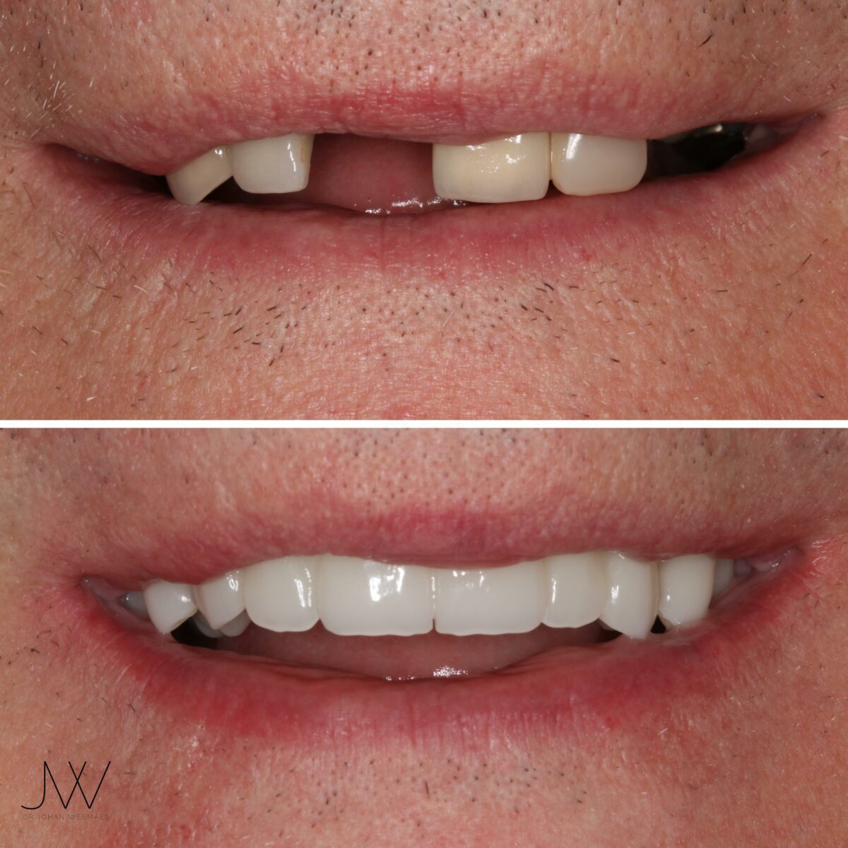 before and after dental implants sunshine coast