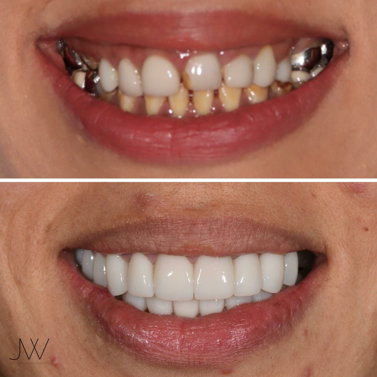 before and after smile makeover sunshine coast
