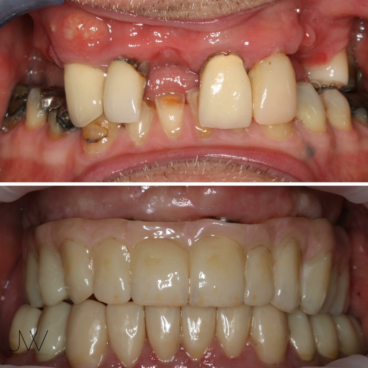 before and after full mouth rehabilitation sunshine coast