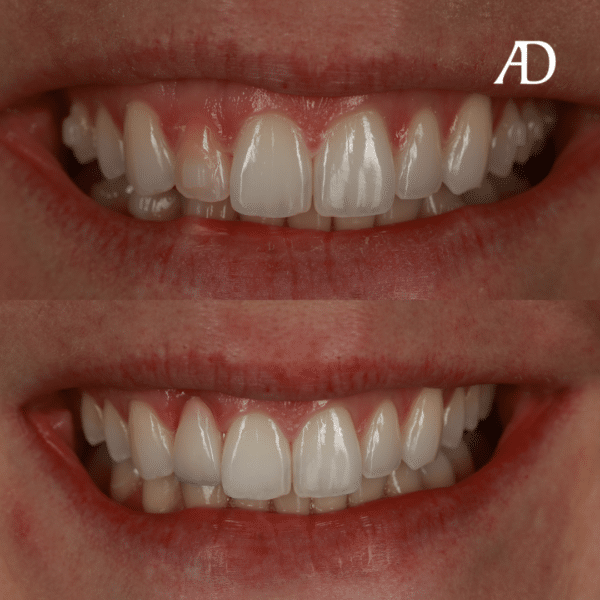 Crowns Avenue Dental