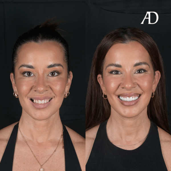Dr Ernesto Villalba (DEN0002568419), Registered dentist, general registration. Treatment: Dental Implants, Invisalign, Veneers and Crowns. Final image taken 2 weeks after final treatment. Results are individual and yours may differ. See risk information linked above.