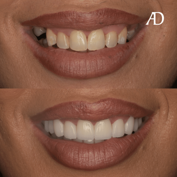 Veneers Brisbane