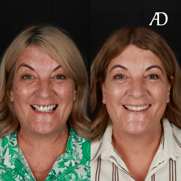 Before and After Dentist Sunshine Coast