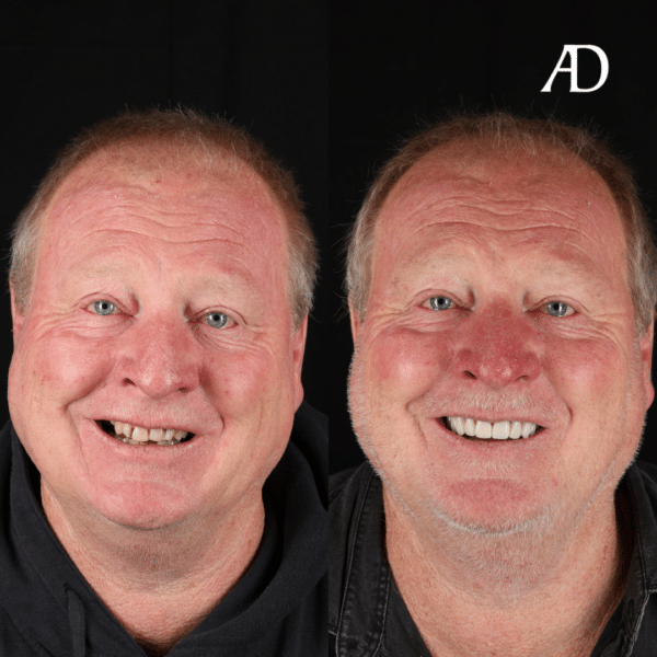 Cosmetic Dentistry Before/After