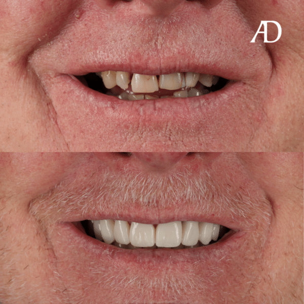 Cosmetic Dentistry Before/After